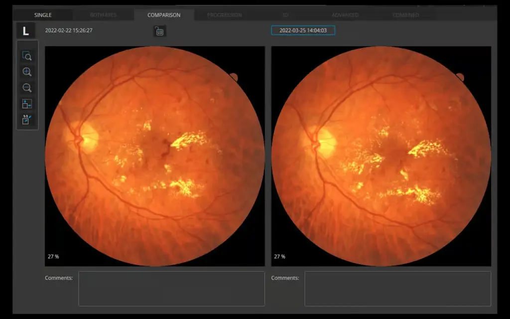 Non-Myad Colour Fundus Camera