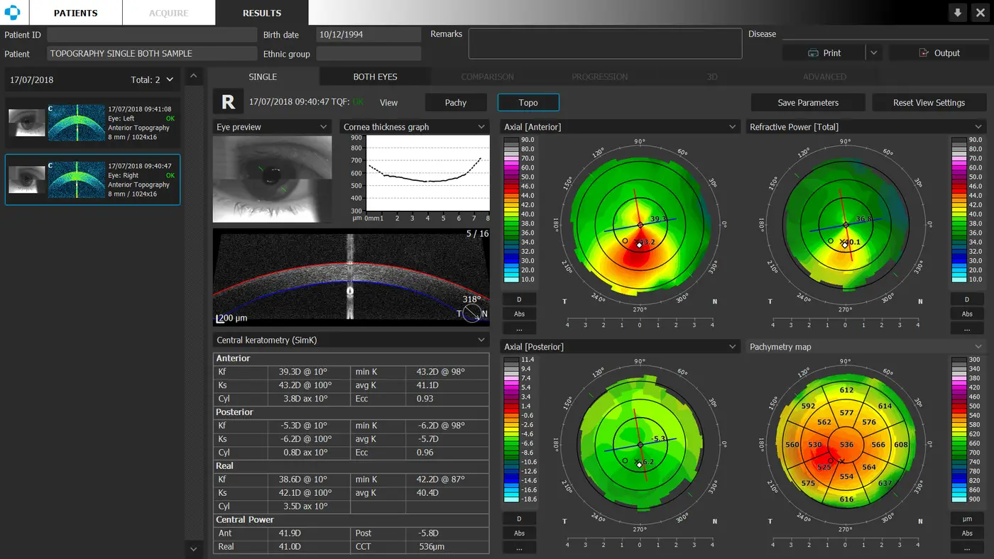 Optopol T-OCT Corneal Topography Software
